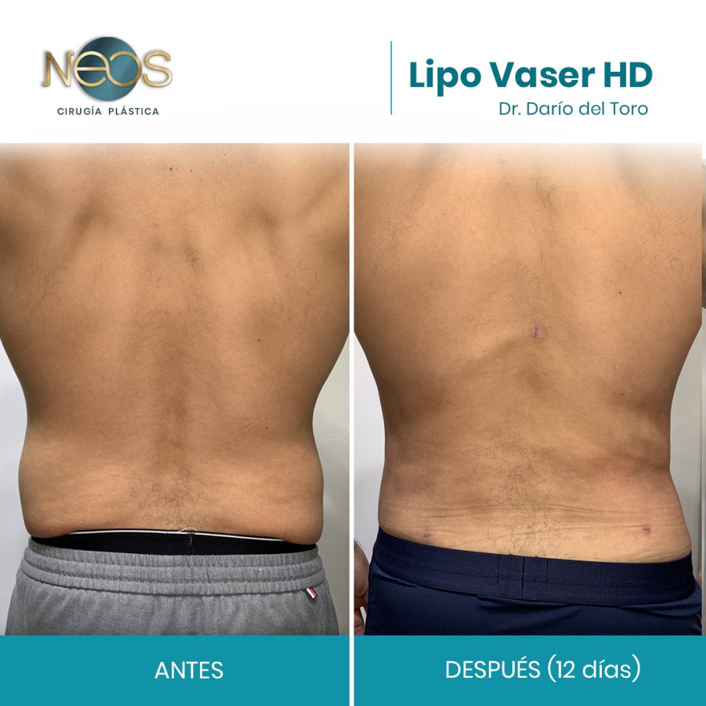 Lipoescultura Vaser De Alta Definici n En Guadalajara Lipoescultura Vaser De Alta Definici n En Guadalajara