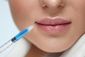 Conoce todo sobre la aplicación de ácido hialurónico en labios